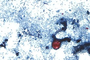07142026 CYCLOSPORIASIS