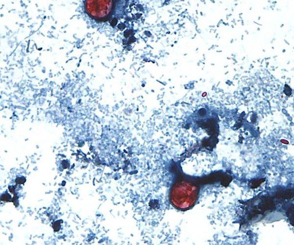 07142026 CYCLOSPORIASIS