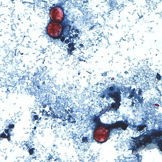 A parasite causing severe diarrhea is spreading through produce. Here's how Georgia says to protect yourself